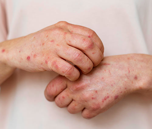 Allergie au Charabis