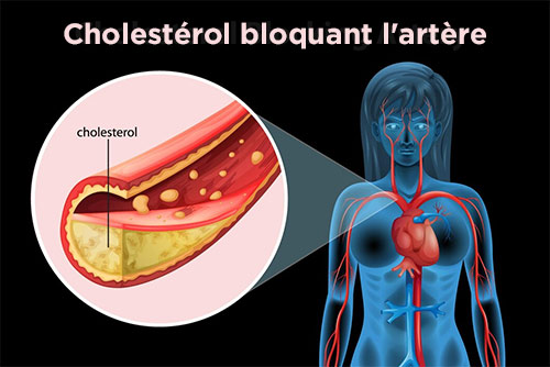 La graisse et le Cholestérol