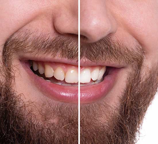 Bien comprendre caries, plaque et tartre